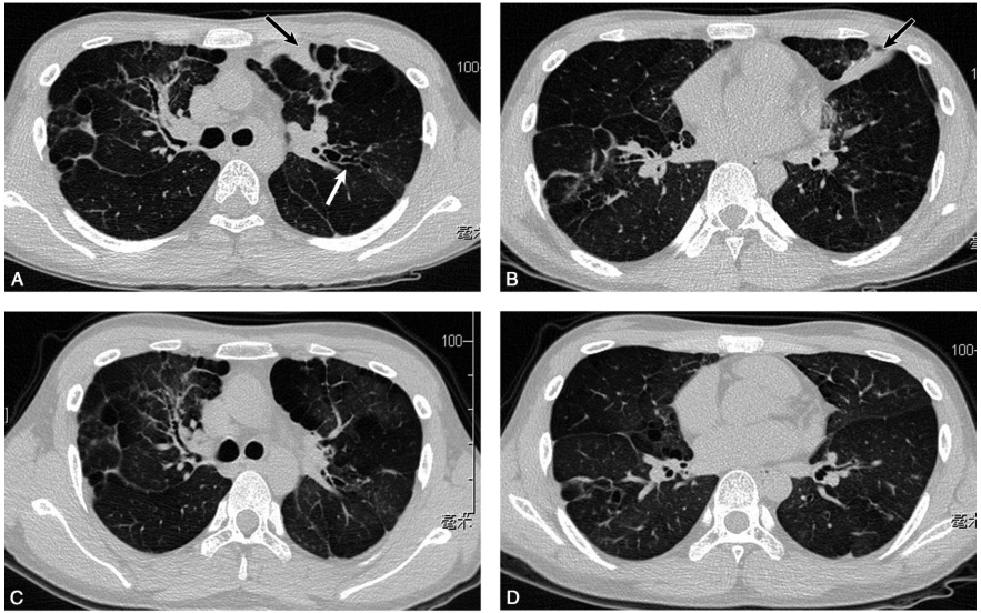 图1 2017年9月20日肺CT（A，B）示双上肺肺大疱、局限性支气管扩张（白箭），局部气道可疑黏液栓，远端肺不张（黑箭）；经过2个月的激素与伊曲康唑口服.jpg